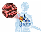 Tuberculosis infection,illustration