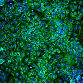 Colon cancer cells,light micrograph