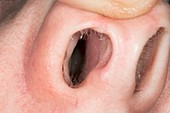 Nasal polyps