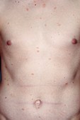 Pityriasis rosea