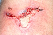 Infected knee laceration