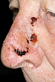 Skin cancer after surgery