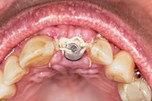 Temporary tooth implant