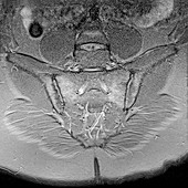 Sacroiliitis,MRI scan