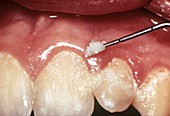 Dental plaque and gum disease