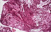 Salivary gland cancer,light micrograph