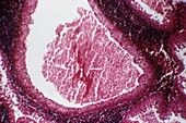 Salivary gland tumour,light micrograph