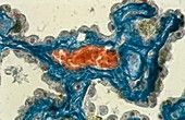 Haemochromatosis in the brain,micrograph