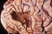 Brain after stroke