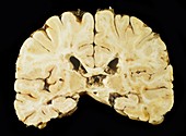 Brain in multiple sclerosis