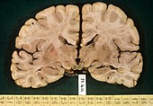 Brain in Wernicke's disease