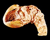 Aorta in syphilis