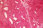 Uterine tumour,light micrograph