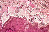 Lymphangioma,light micrograph