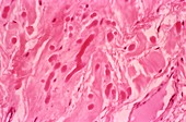 Elastofibroma,light micrograph