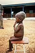 Child with kwashiorkor