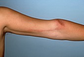 Inflamed lymph vessels in the arm