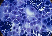 Cancer cells,light micrograph