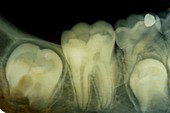 Dental X-ray,6-year-old child