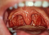 Normal throat and tonsils