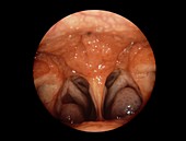 Normal nasopharynx