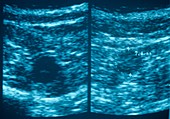 Deep vein thrombosis,ultrasound