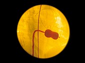 Heart valve balloon dilatation,X-ray