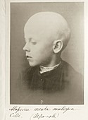 9 year old boy with alopecia,1890