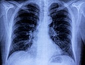 Lungs and heart,chest X-ray