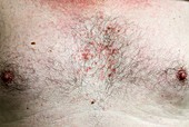 Folliculitis of the chest