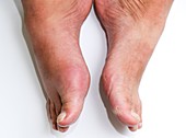 Gout of the big toe