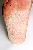 Eczema of the foot