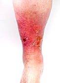 Leg ulcers in lipodermatosclerosis