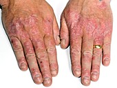 Psoriasis of the hands