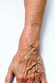 Tenosynovitis of the wrist