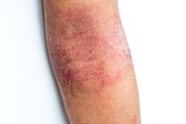 Eczema of the elbow