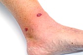 Cellulitis after insect bite