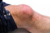 Prepatellar bursitis