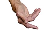 Rheumatoid arthritis of the hand