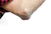 Rheumatoid nodule of the elbow