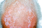 Vitiligo of the scalp