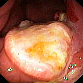 Stomach cancer,endoscope view