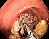Colon cancer,endoscope view