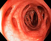Diverticular disease in the colon
