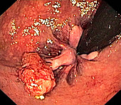 Anal polyp,endoscope view