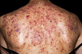 Cystic acne