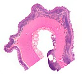 Human bowel lymphoma,light micrograph