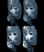 Metastatic bladder cancer,MRI