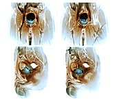 Metastatic bladder cancer,MRI