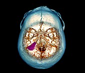Brain tumour,3D CT scan